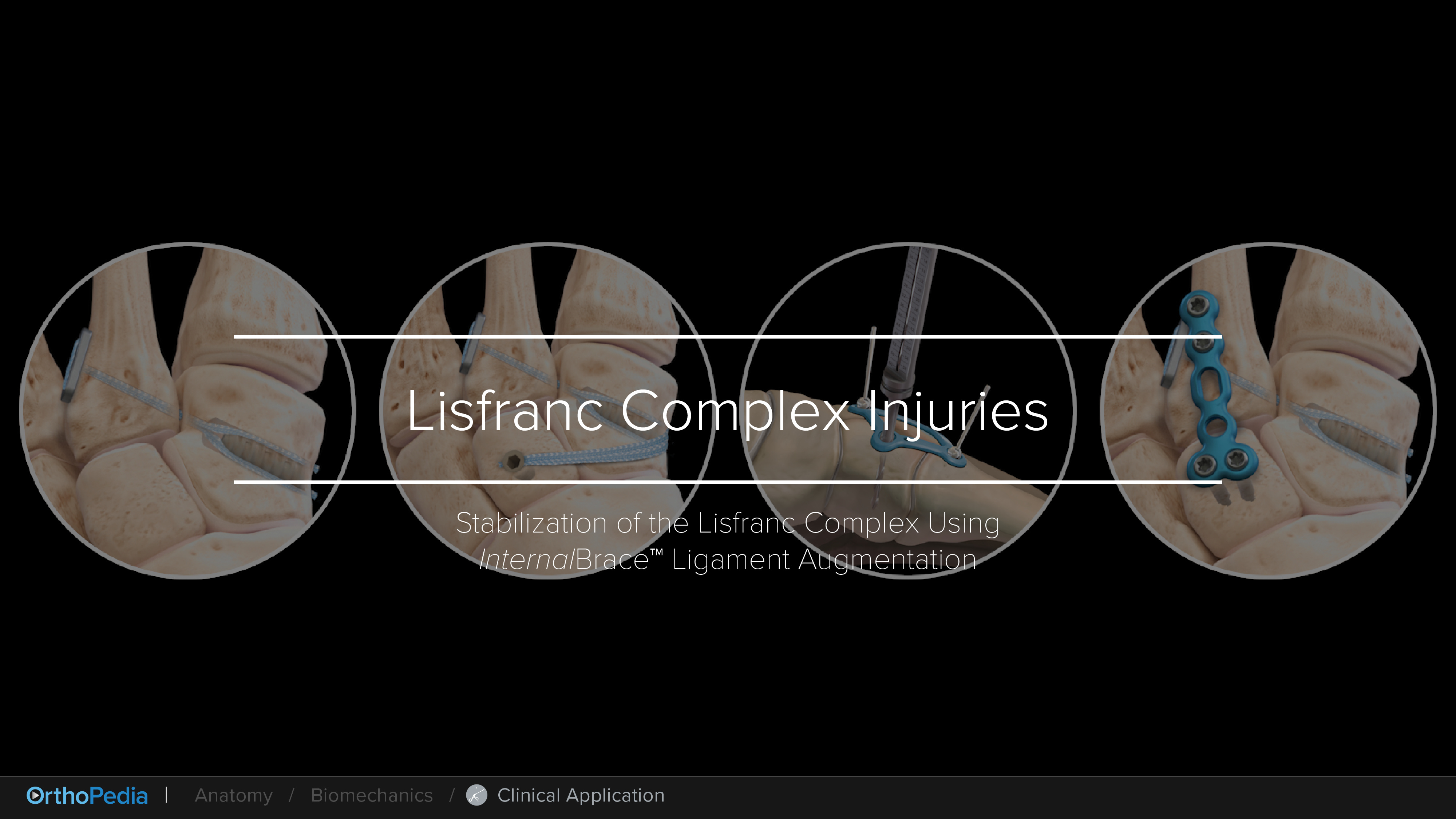 Lisfranc Complex Injuries Stabilization of the Lisfranc Complex Using