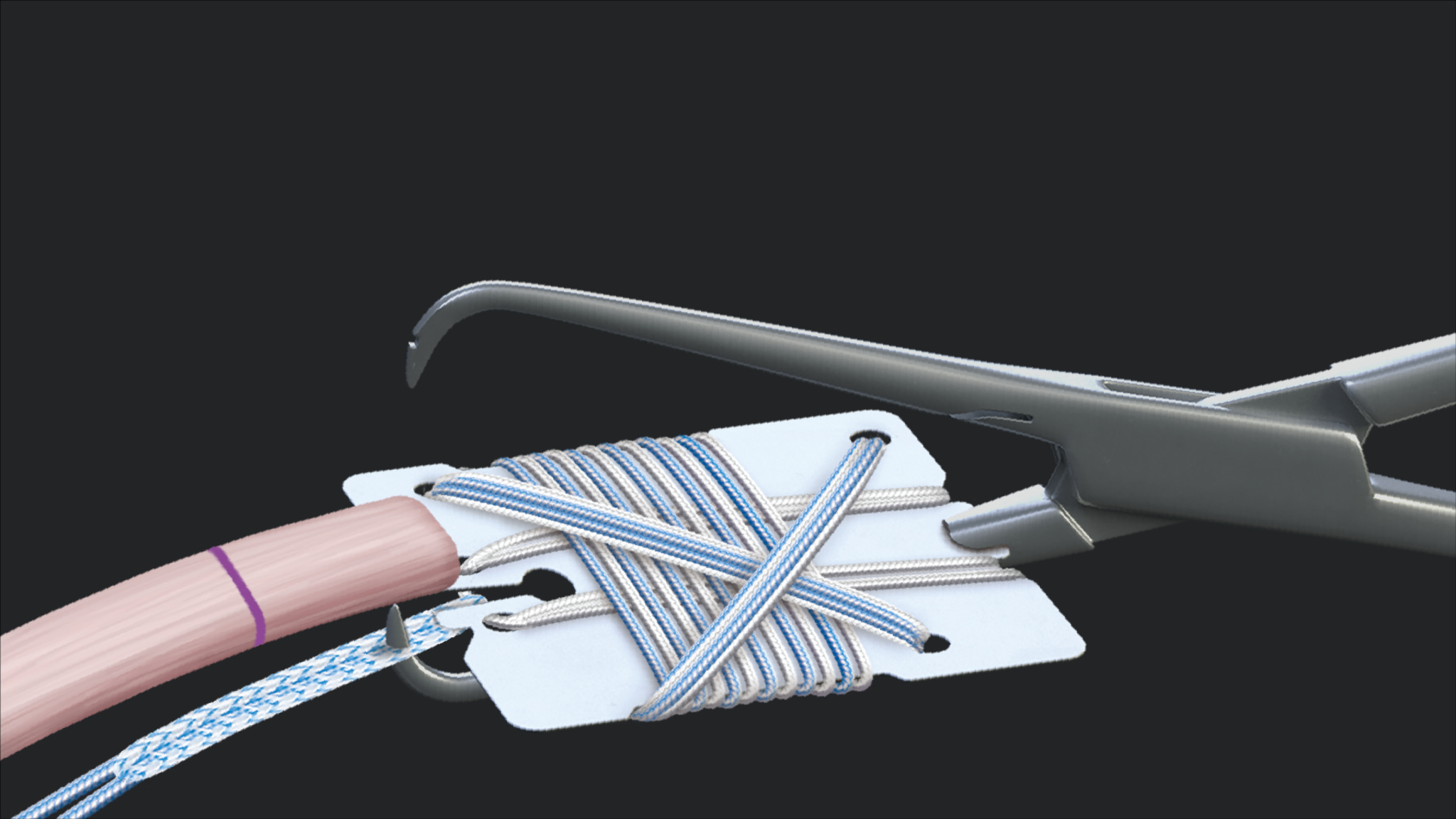 Arthrex FiveStranded Hamstring Graft Using FiberTag® TightRope® Implant