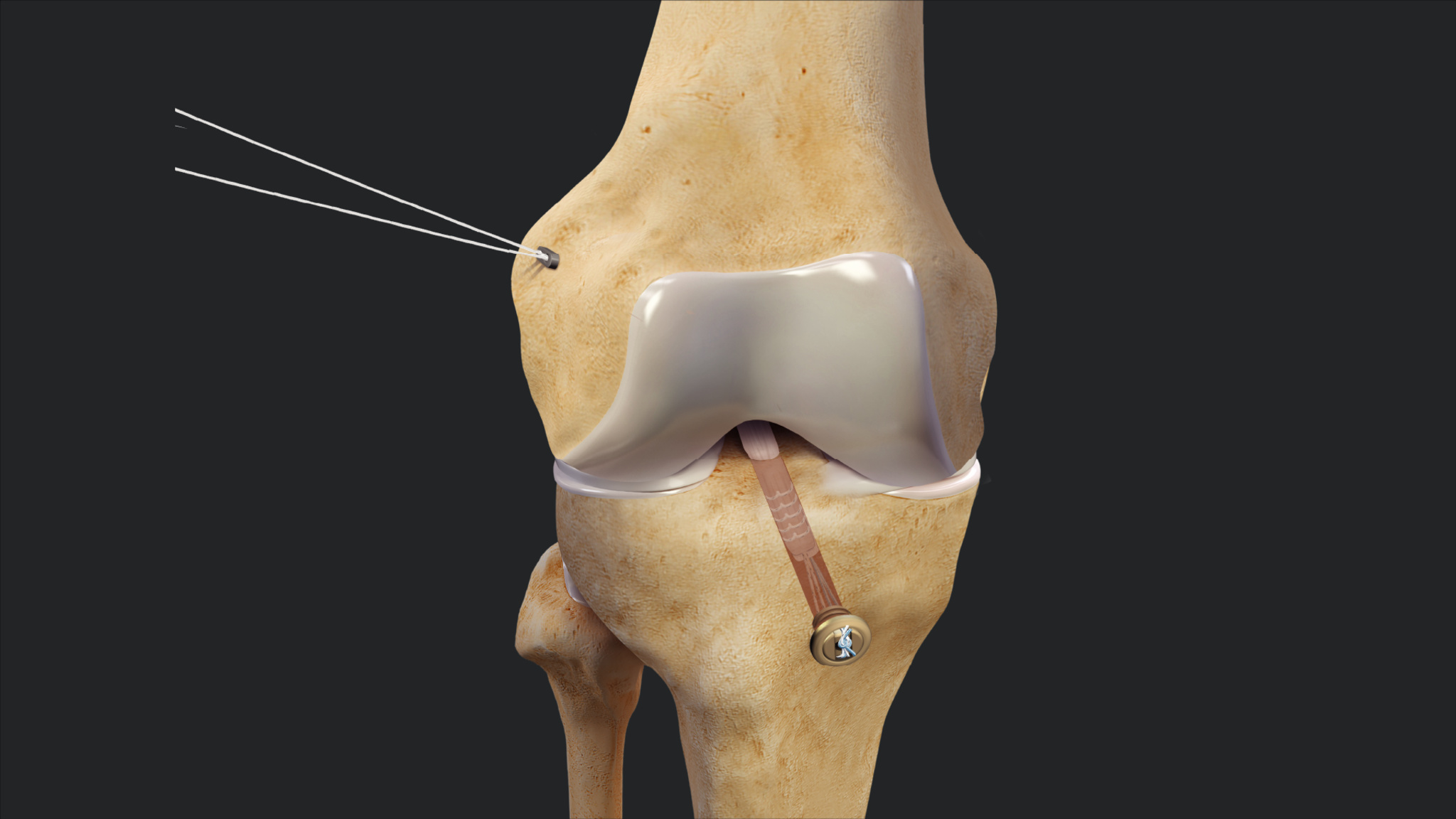 Arthroscopic Knee Surgery For Torn Ligament At Aletha Heidelberg Blog