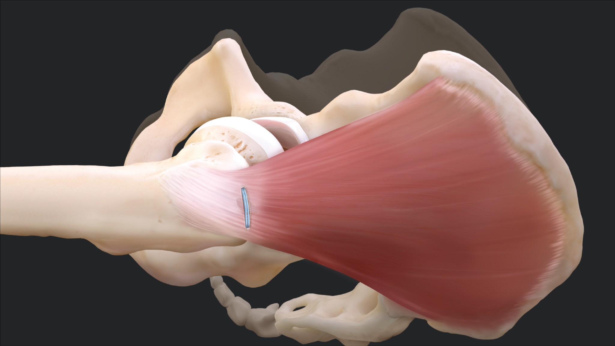 Arthrex Knotless Compression Bridge for Abductor Tendon Repair