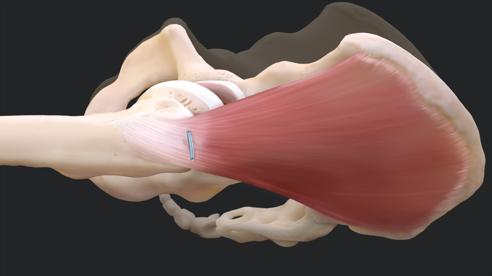 Arthrex PartialThickness Gluteus Medius Repair Using the 2.6
