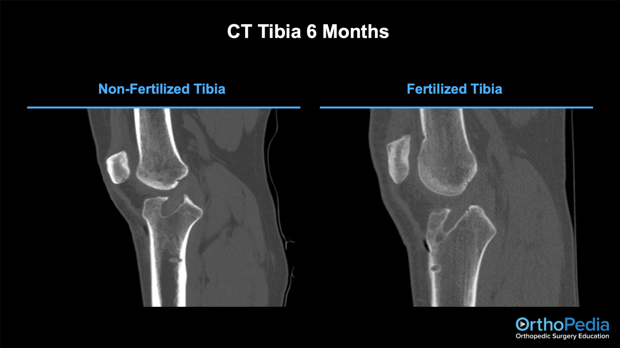Arthrex Improving Outcomes Through Biologic Acl Augmentation
