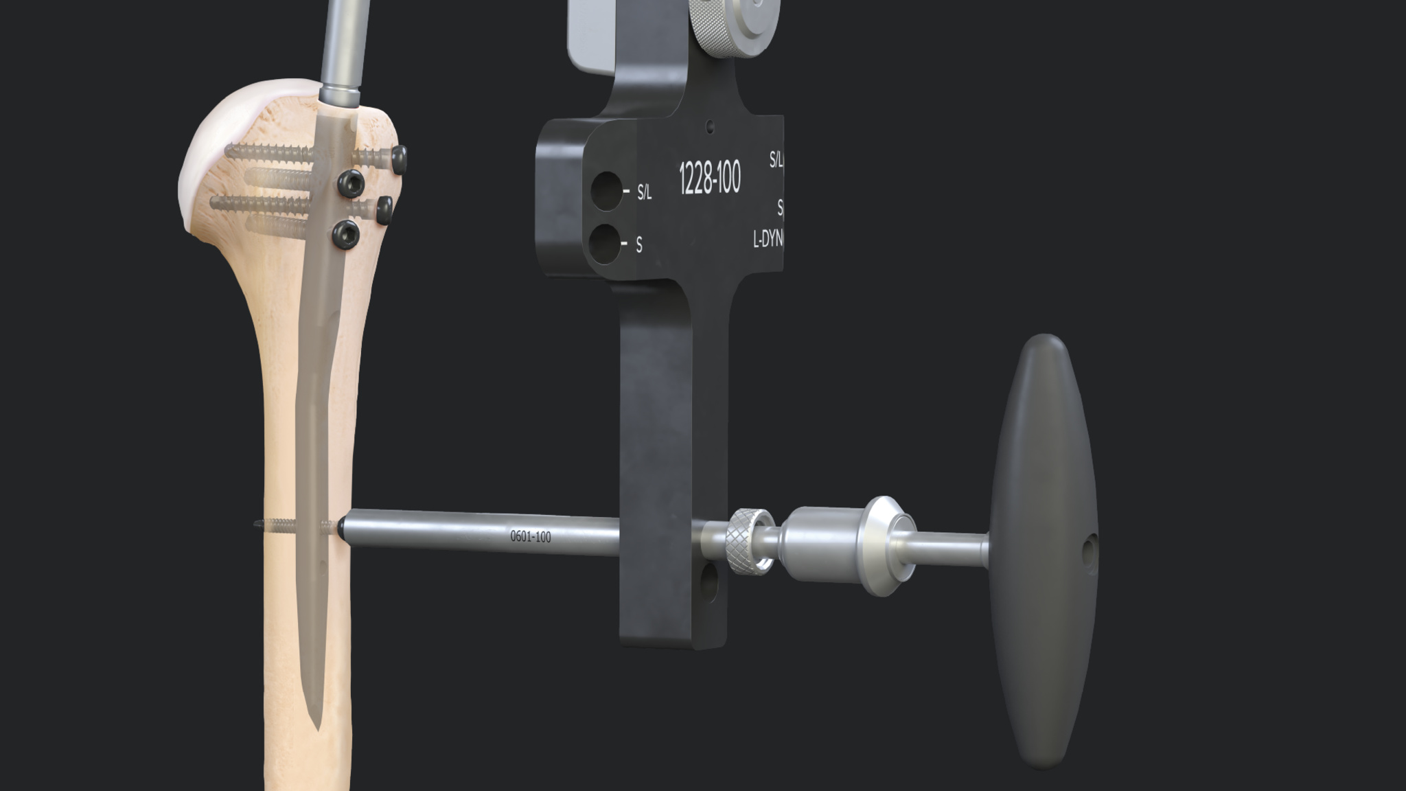 Arthrex - Humeral Fracture Repair Using the Arthrex Humeral Nail