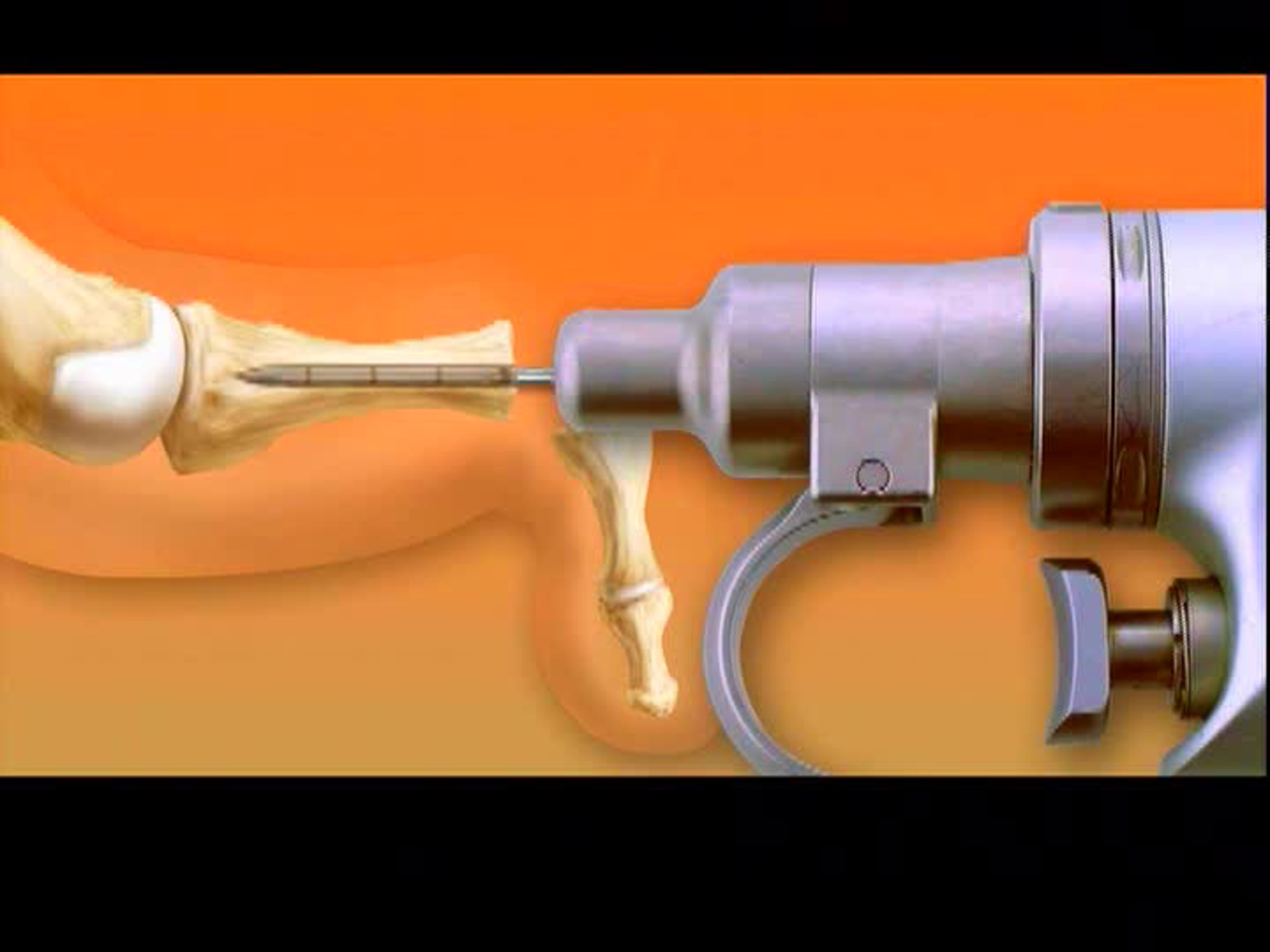 Arthrex Proximal Interphalangeal Fusion For Claw & Hammertoe