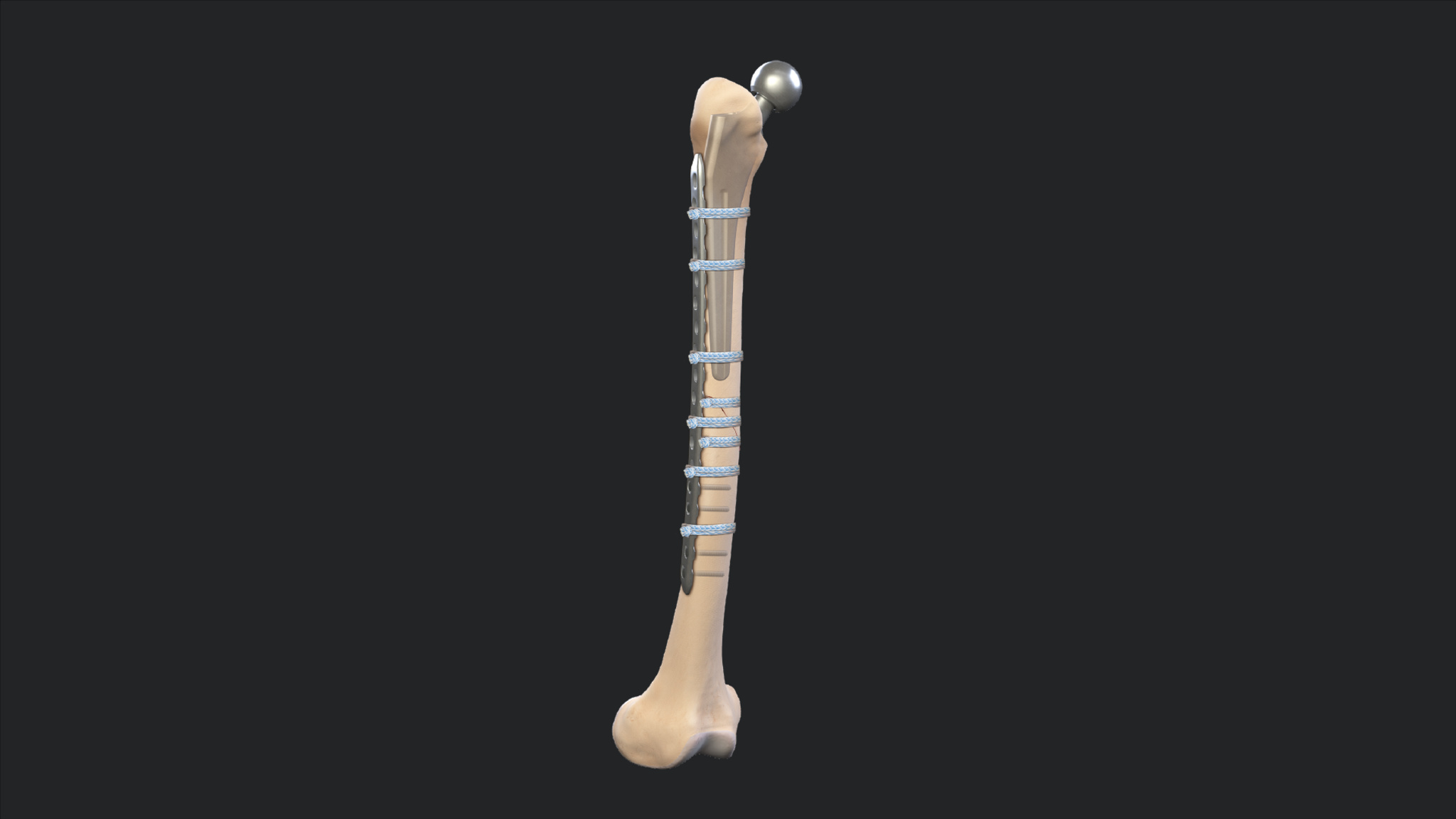 Arthrex FiberTape Cerclage Fixation Of Periprosthetic Hip Fractures arthrex-fibertape-cerclage-fixation-of-periprosthetic-hip-fractures
