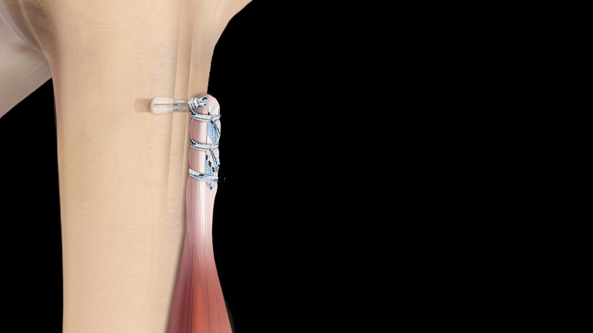 Arthrex FiberTak® Button With SutureTag Looping Stitch