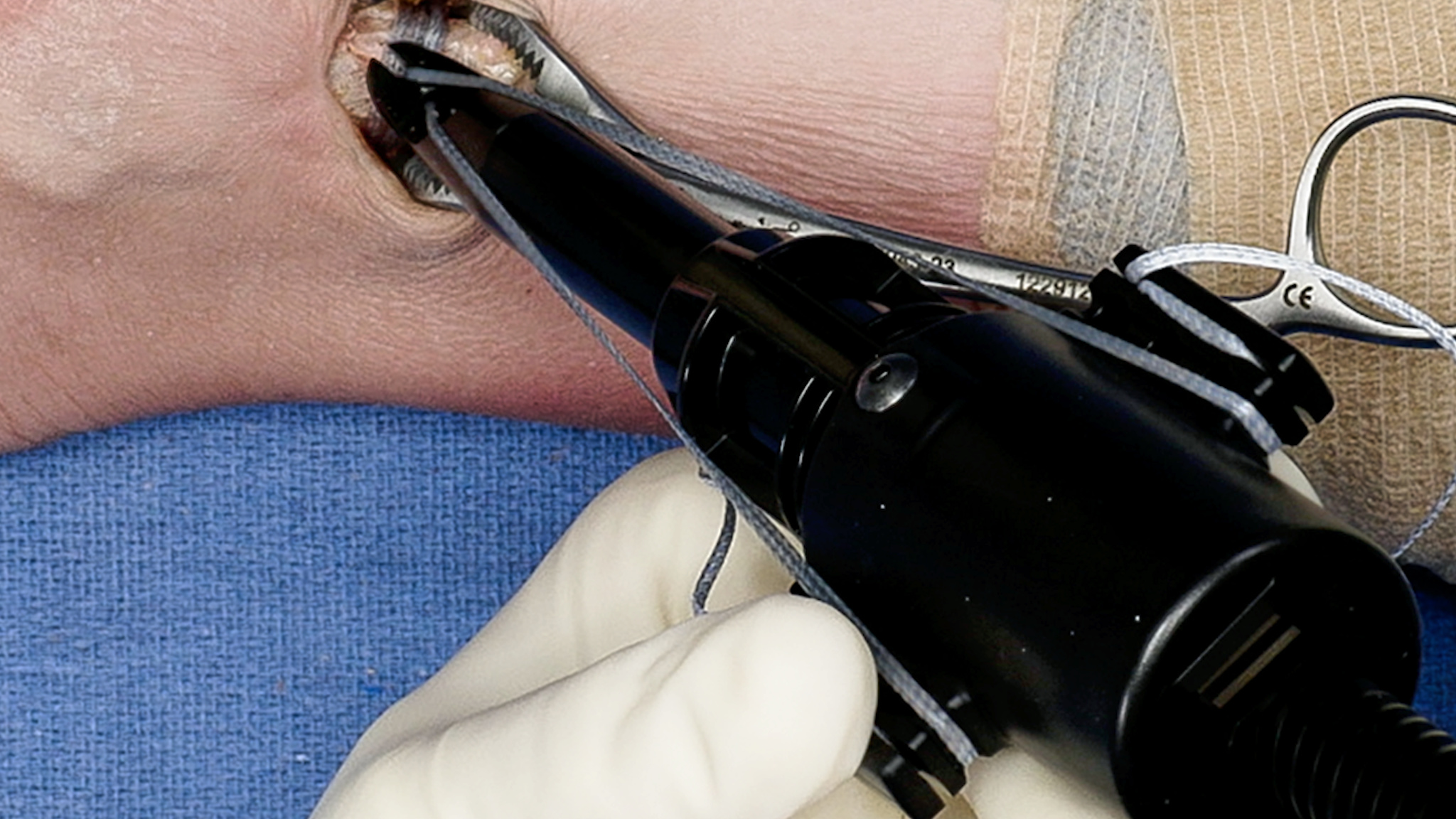 Arthrex Ankle Fracture Stabilization Using FiberTape® Cerclage and