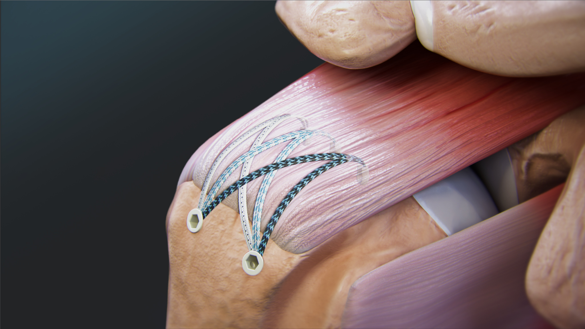 Arthrex - FiberTak® SpeedBridge™ Rotator Cuff Repair
