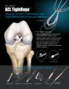 The Arthrex® ACL TightRope® - Advanced ACL/PCL Graft Fixation with Unparalleled Clinical Outcome Validation