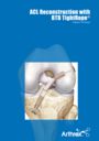 ACL Reconstruction with BTB TightRope®