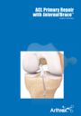 ACL Primary Repair with InternalBrace™