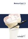 Meniscal Cinch™ II