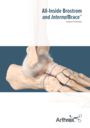 All-Inside Brostrom and InternalBrace™