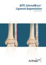 AITFL InternalBrace™ Ligament Augmentation