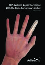 The Arthrex FDP Avulsion Repair Technique with Nano Corkscrew® Anchor
