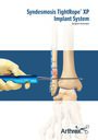 Syndesmosis TightRope® XP Implant System
