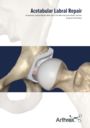 Acetabular Labral Repair