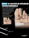 ¡Inove na correção da articulação metatarsofalângica! - Reparo Completo da Placa Plantar (CPR™)