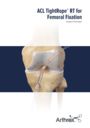 ACL TightRope® RT for Femoral Fixation