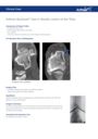 Arthrex Quickset™ Use in Geodic Lesion of the Tibia