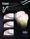 Knee Scorpion™ - Simplified, Single-Portal Suture Passing and Retrieving
