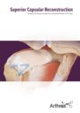 Superior Capsular Reconstruction