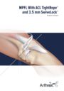 MPFL With ACL TightRope® and 3.5 mm SwiveLock®