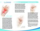 Carpal Tunnel Syndrome (CTS)