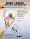 Freedom in Anatomic Femoral Socket Placement