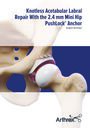 Knotless Acetabular Labral Repair with the 2.4-mm Mini Hip PushLock® Anchor