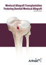 Dovetail Meniscal Allograft Technique