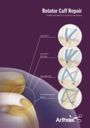Rotator Cuff Repair - Fulfilling the Need for Precision and Speed