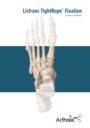 Lisfranc TightRope® Fixation
