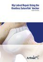 Hip Labral Repair Using The Knotless SutureTak® Anchor