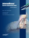InternalBrace™ Ligament Augmentation Repair - Deltoid Ligament