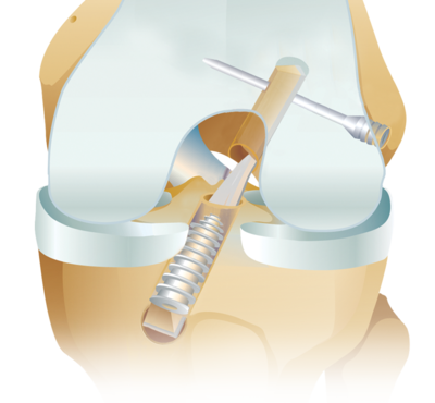 Biocomposite transfix 0 large