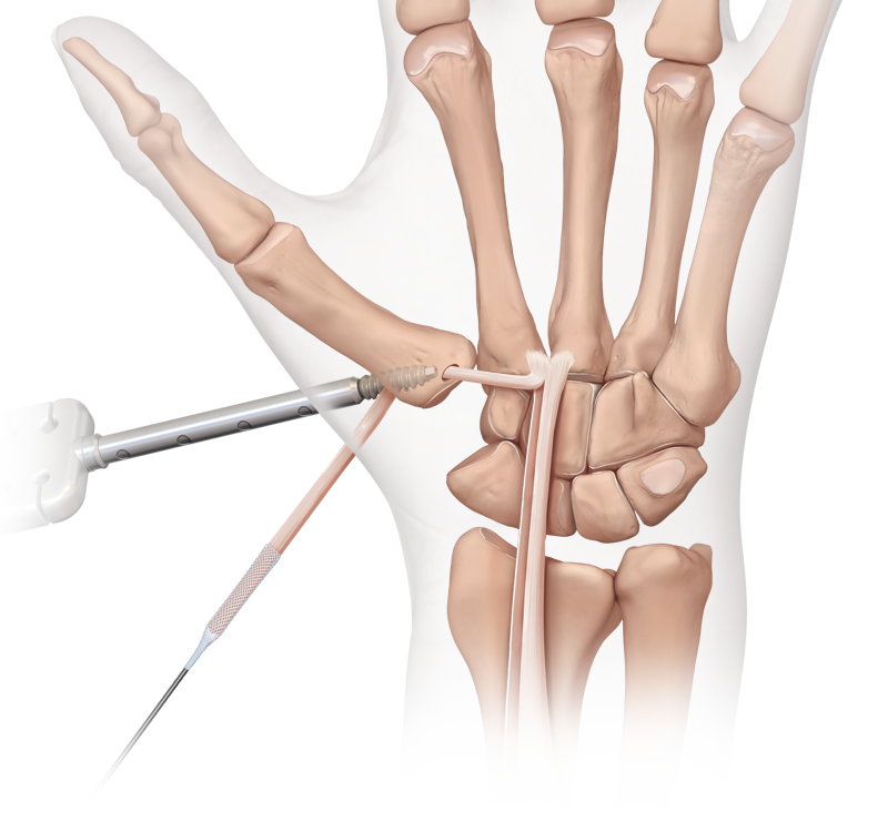 Arthrex CMC Arthritis Arthrex CMC Arthritis