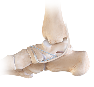 Cortical button fixation 1 large