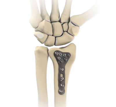 Distal radius plates and screws 0 large