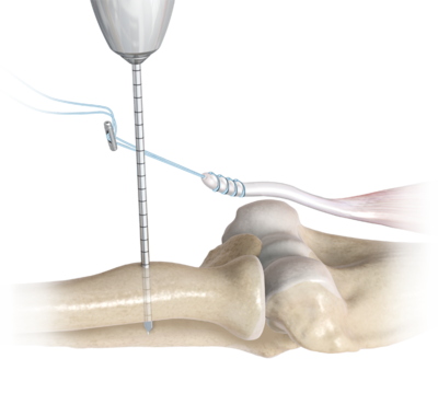 Elbow button fixation 0 large