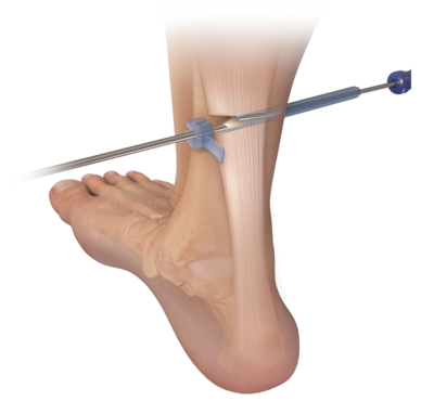 Endoblade system 0 large