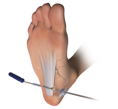 myofascial release plantar fascia