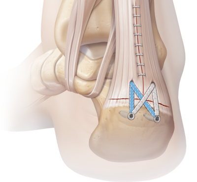 Foot and ankle soft tissue fixation devices 0 large