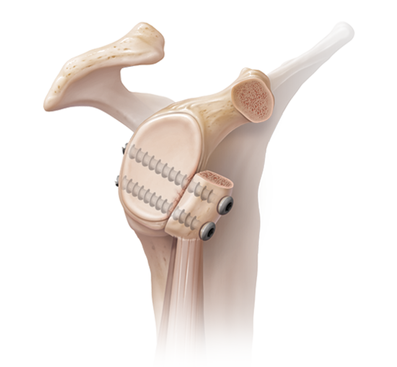 Arthrex Inestabilidad Glenohumeral Ruptura Del Labrum