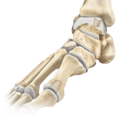 Hallux rigidus oats technique 0 large