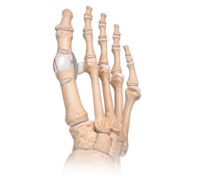 Hallux varus internalbrace ligament augmentation repair 0 large