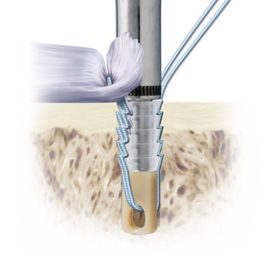 Hand and wrist knotless suture anchors 0 large