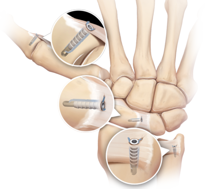 Hand and wrist soft tissue fixation devices 0 large