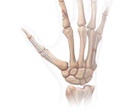 Interphalangeal fusions 0 large