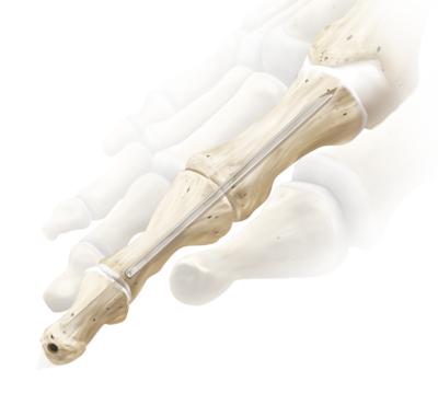 Interphalangeal Joint Fusion